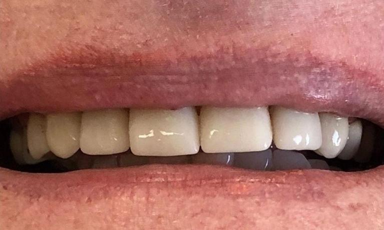 Anterior-Crowns-After-Image