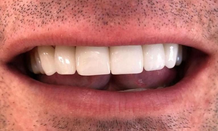 Anterior-Crowns-After-Image