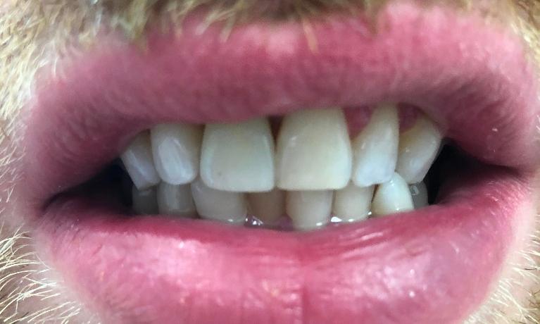 Anterior-Implant-After-Image