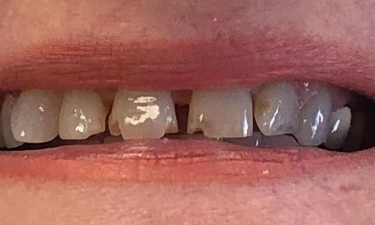Anterior-Crowns-Before-Image
