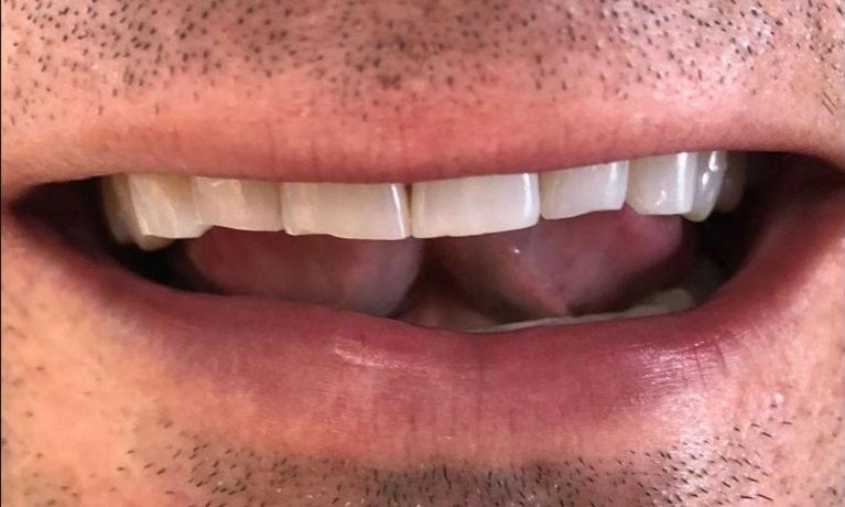 Anterior-Crowns-Before-Image