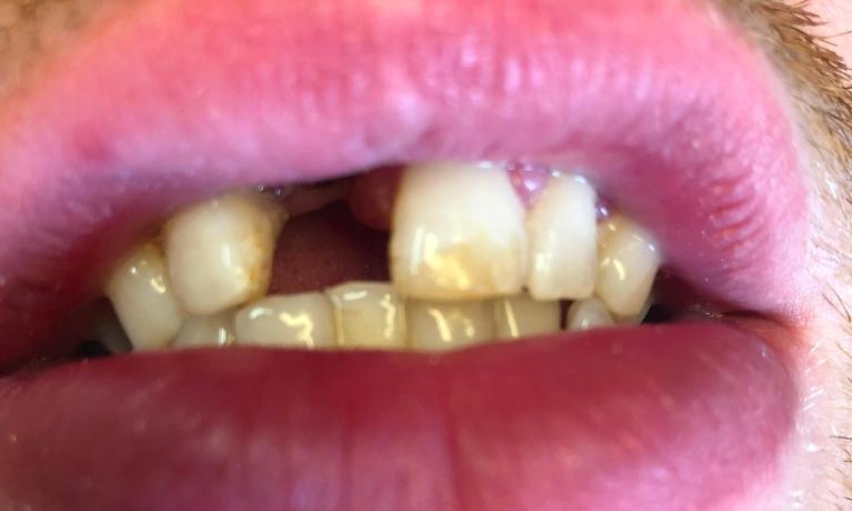 Anterior-Implant-Before-Image