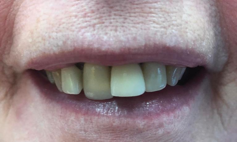 Replace-Anterior-Crowns-Before-Image